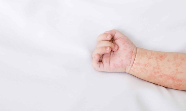 Bouton rouge bébé : quelles sont les causes et comment traiter ?